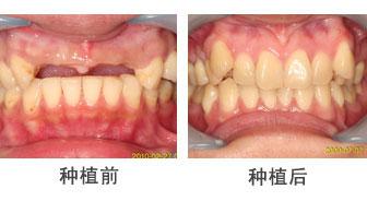 1,牙齿本身的情况:种植牙周围的牙健康,使用寿命就长;若种植牙